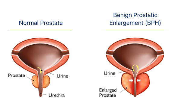 Diagram - normal versus enlarged prostate (BPH)