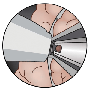 Cystoscopic View