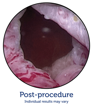 Post-Procedure image-2