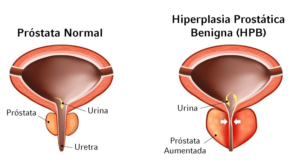 UroLift BPH Diagram PT