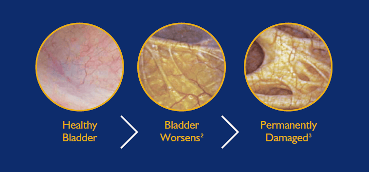 Bladder disease progression - untreated BPH