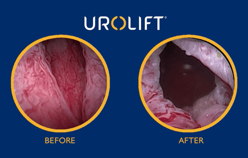 UroLift before and after pictures