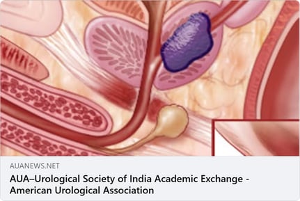 AUA article - USIA Exchange UroLift
