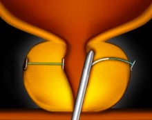 urolift-system.jpg