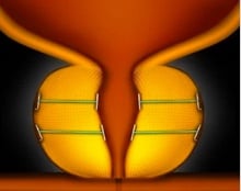 urolift-system.jpg