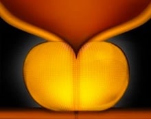 urolift-system.jpg