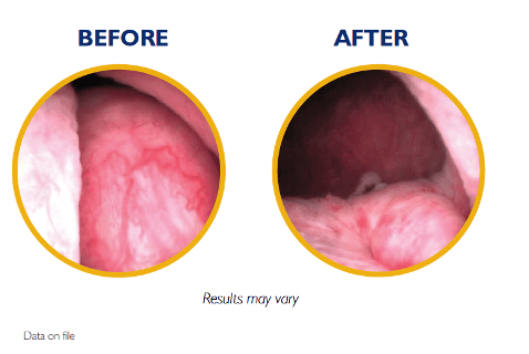 Before and after photos of the UroLift 2 ATC system