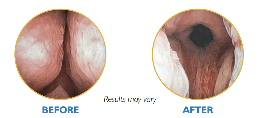 Before and after photos of the UroLift procedure