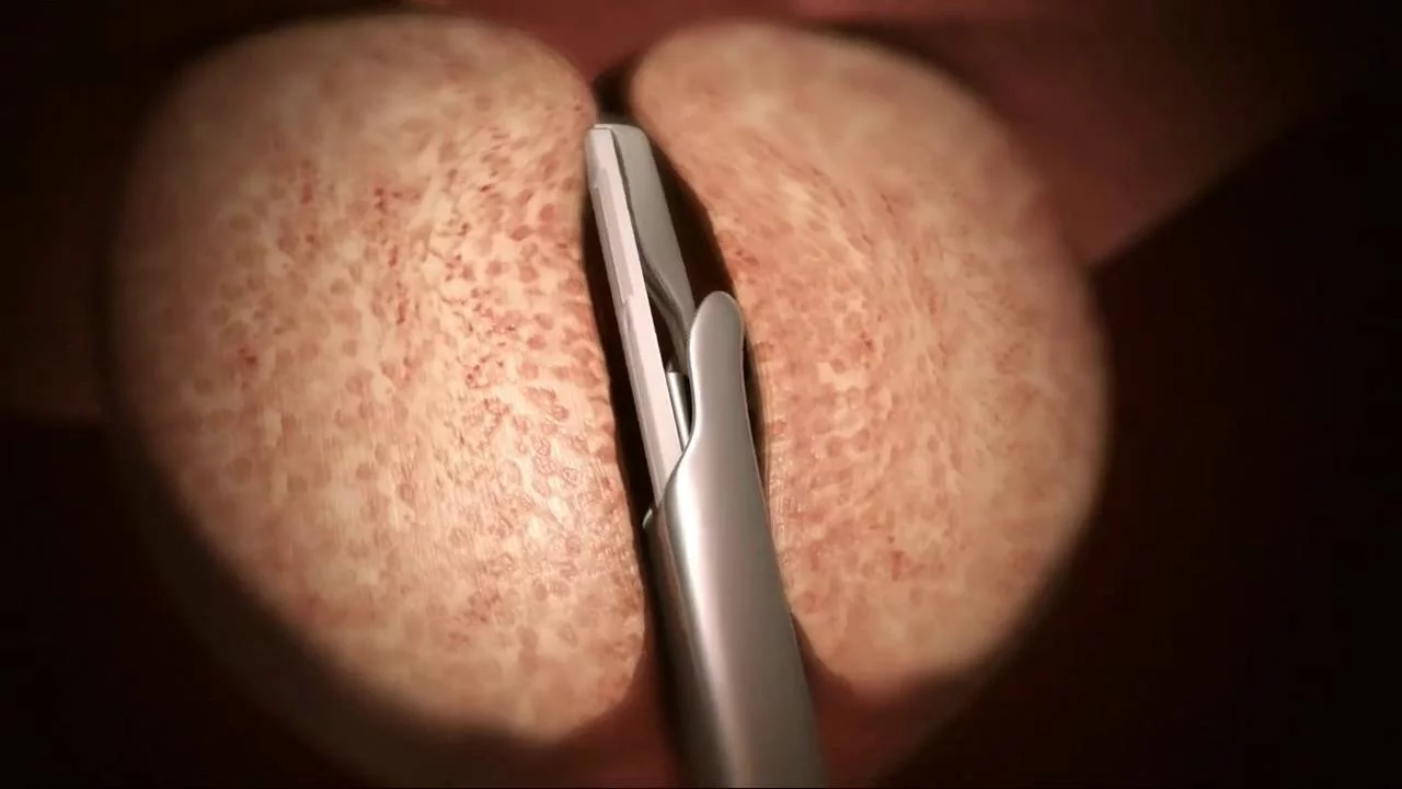 urolift-video-thumbnail